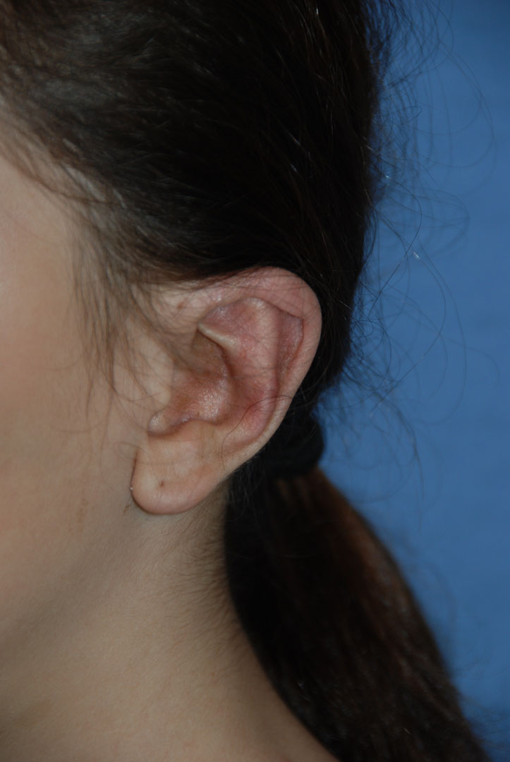 Cup Lop Constricted Ear After Otoplasty Left Oblique Close up